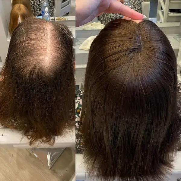 Antes y después de un topper femenino: coronilla con poco volumen y después con el cabello completo