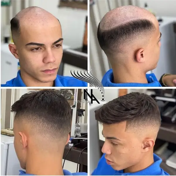Antes y después de una prótesis capilar masculina con acabado degradado, vistas lateral y posterior